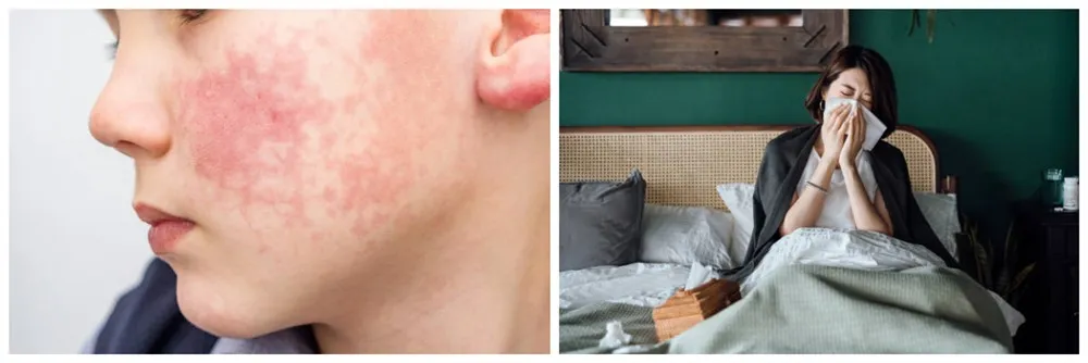 allergic reaction allergic reaction